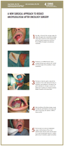 A New Surgical Approach to Reduce Anchyloglossia after Oncology Surgery